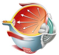 glaucoma treatment