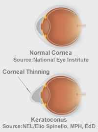 keratoconus